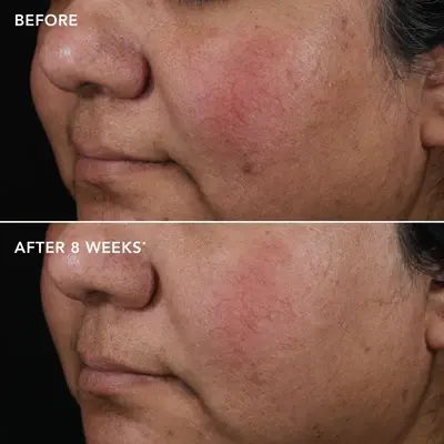Thumbnail: AGELESS+ Retinol Pure Liquid Retinol 0.75% (Prescription Only)