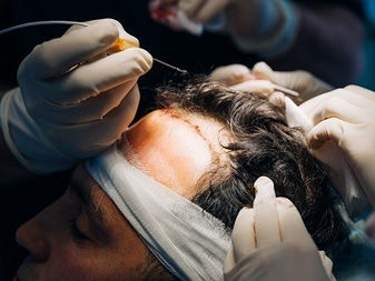 What is the cost of a hair transplant?