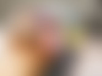 PICO Laser for Birthmark and Spot Removal in Islamabad