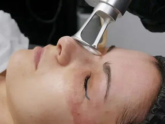 Latest Trends in CO2 Laser Treatments in Islamabad