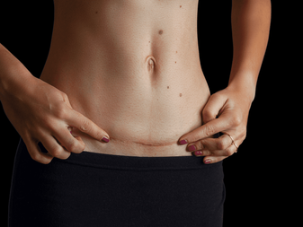 Common Myths About Abdominoplasty in Islamabad – Busted!