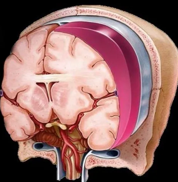 Subdural 1.png