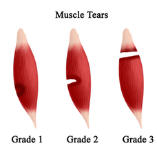 Breaking Point: The Physiology of Muscle Strains and Tears