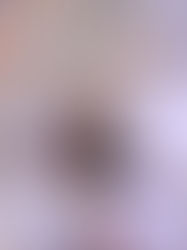 Ozonioterapia no pós Covid-19