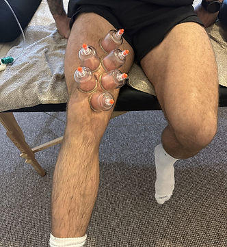 Cupping therapy of the quad muscle