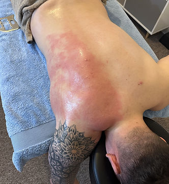 Redness across the back following graston technique