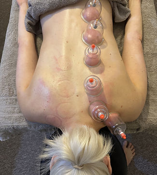 cupping therapy on the back