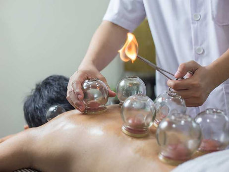 Cupping-para-espalda.jpg
