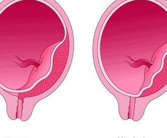 Types-of-placenta-previa-Illustration-Jo