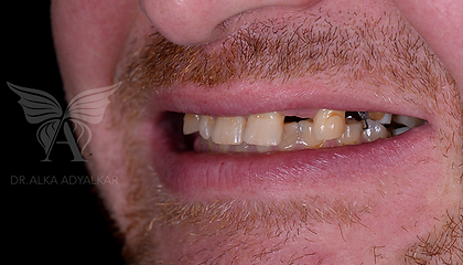 Dr. Alka Adyalkar, Dental Implant Treatment
