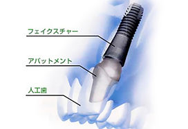 インプラントフィクチャー埋入の手術