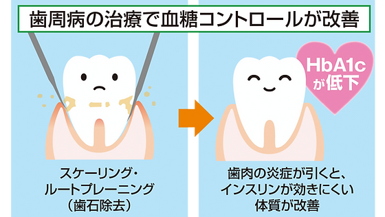 歯周病治療 新潟市中央区の歯科ならよしだ歯科医院