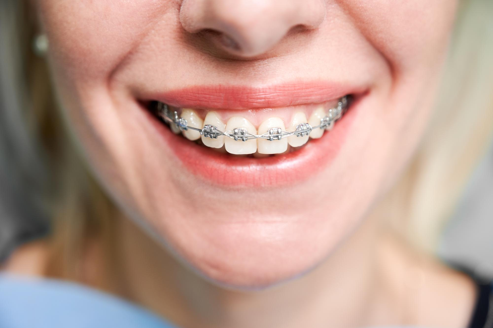 Tratamiento de ortodoncia en Dentagral