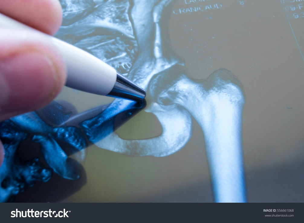 stock-photo-x-ray-of-hip-joint-doctor-pointed-on-area-of-hip-joint-where-pathology-is-dete