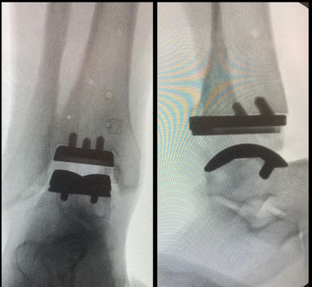 ARTROPLASTIA DE TORNOZELO!