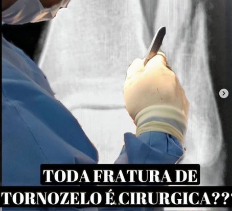 Toda Fratura do Tornozelo É CIRURGICA?