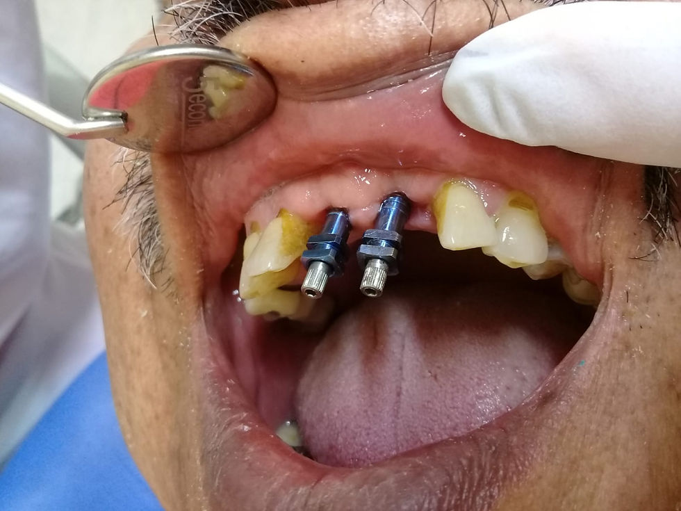 Implantes Dentales