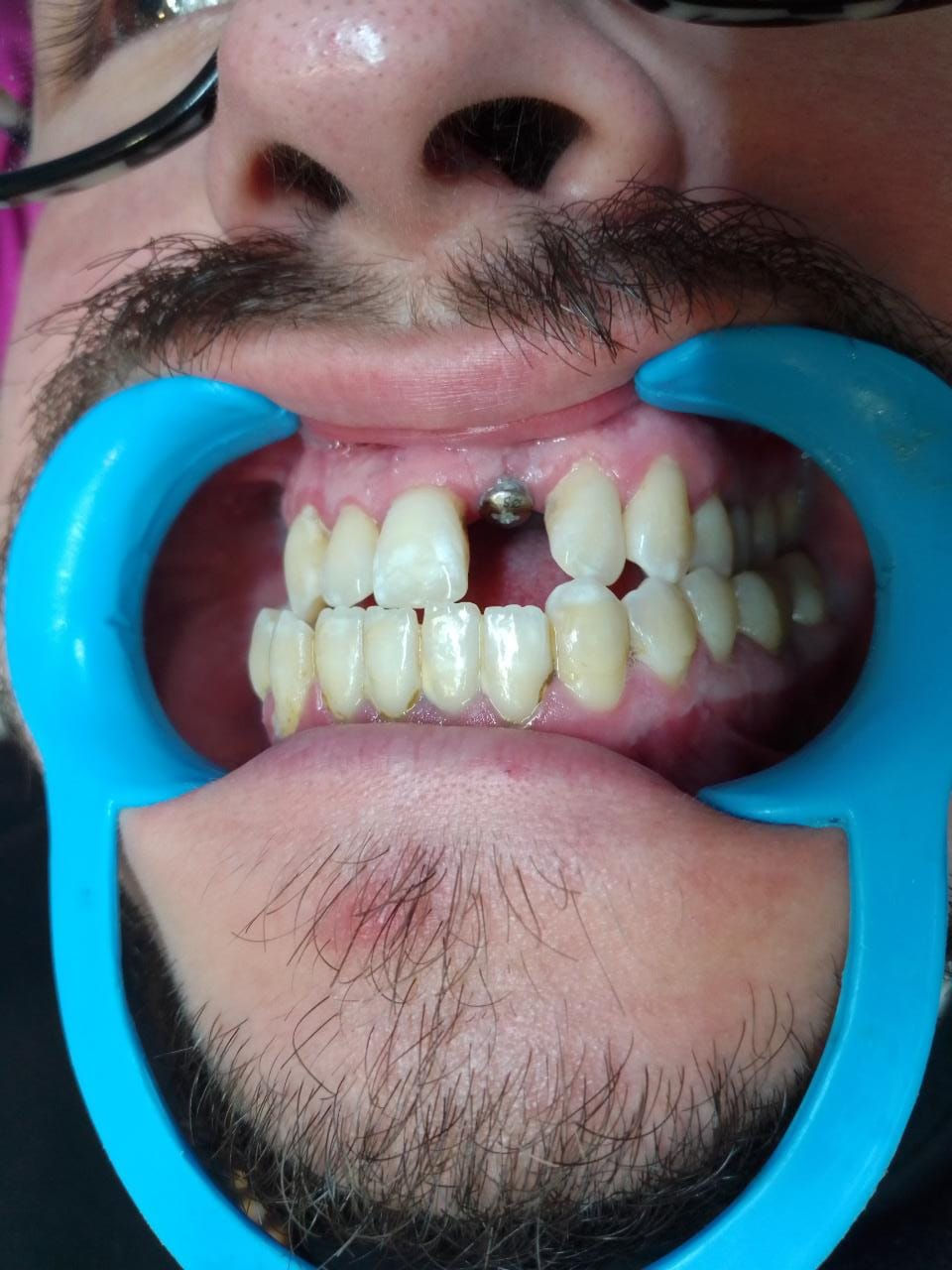 Implantes Dentales