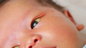 How to Spot Early Signs of Jaundice in Newborns