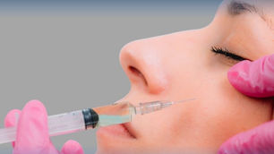 الفيلر في أذربيجان