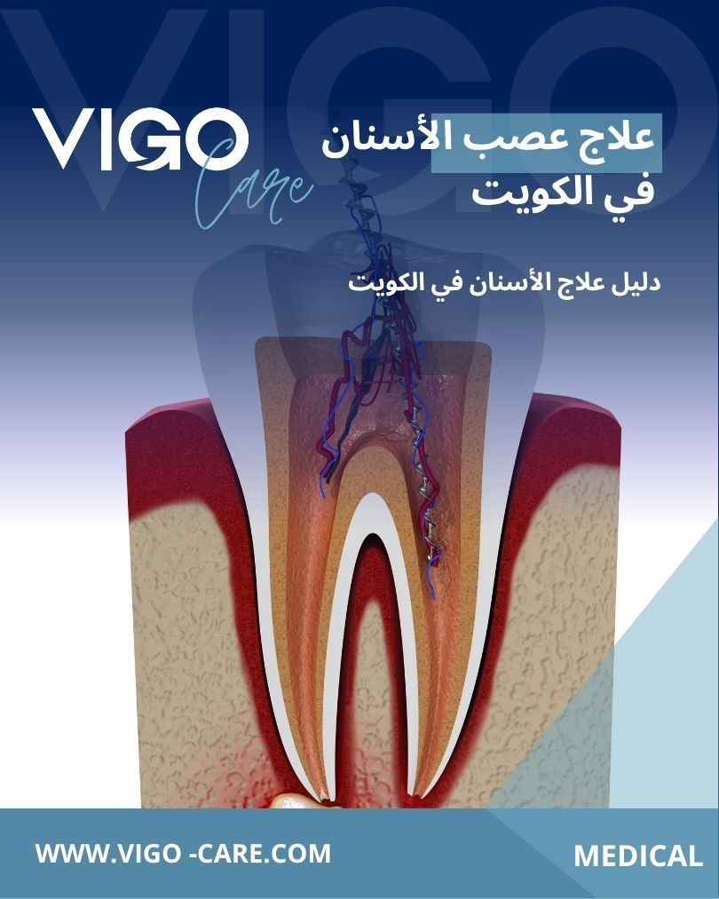 علاج عصب الأسنان في الكويت - دليل علاج الأسنان في الكويت