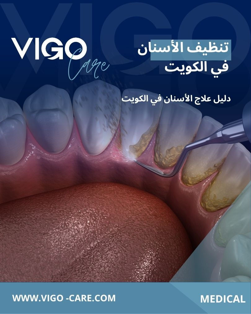 تنظيف الأسنان في الكويت - دليل علاج الأسنان في الكويت