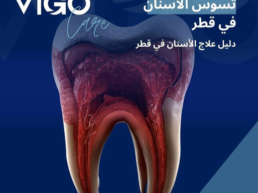 يُعد تسوس الأسنان في قطر من أكثر أمراض الفم شيوعًا لدى الأطفال والبالغين، وهو مشكلة صحية يمكن الوقاية منها وعلاجها بسهولة عند اكتشافها مبكرًا. توفر قطر خدمات متقدمة في تشخيص وعلاج تسوس الأسنان، تعتمد على أطباء أسنان متخصصين، تقنيات حديثة، وخطط علاج دقيقة تهدف إلى الحفاظ على الأسنان الطبيعية ومنع المضاعفات. تسوس الأسنان في قطر - دليل تسوس الأسنان في قطر