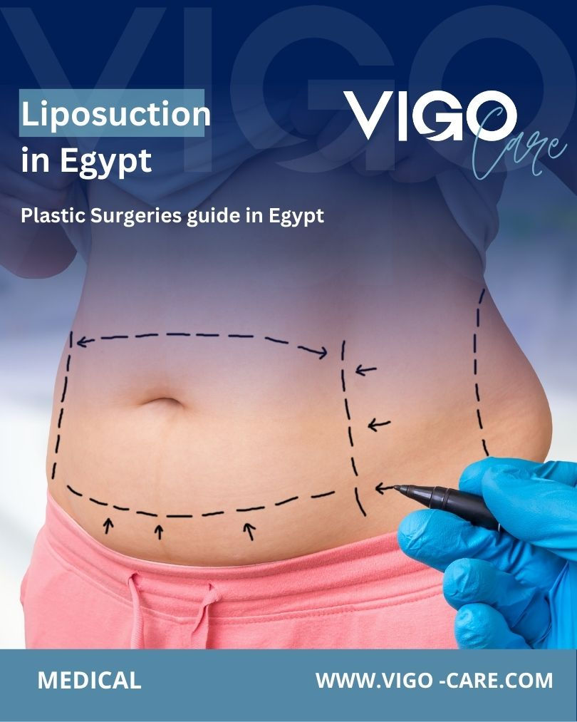 Liposuction in Egypt is one of the most widely performed cosmetic procedures for individuals seeking to remove stubborn fat deposits and improve body contours. Liposuction in Egypt - Liposuction in Egypt Guide.