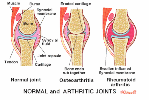 FROZEN JOINTS! Why Weather Changes Can Cause Joint Pain.