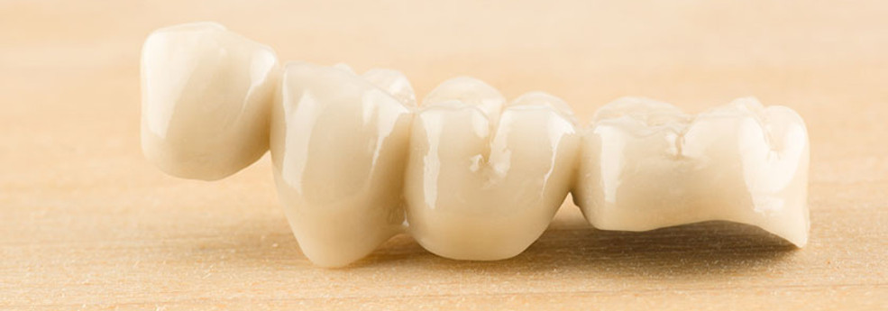 Ponte-Dentale-01-Dentista.Tv_.jpg