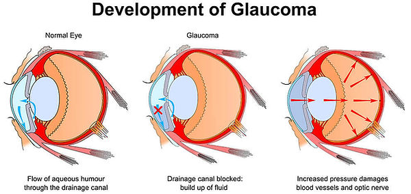 Development of Glaucoma.jpg