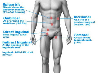 Hernia