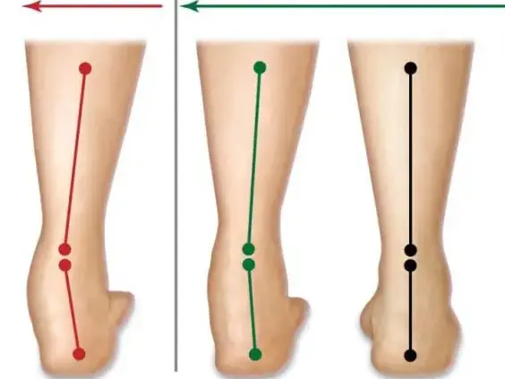 Over pronation Custom Insoles