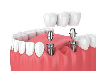 implant-supported-bridge_NewMouth-scaled.jpeg