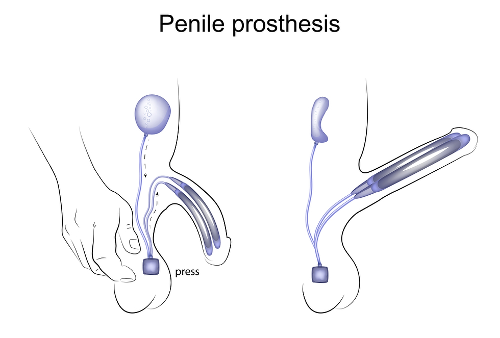 Penile Implant Before and After