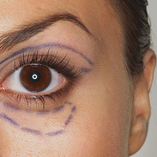 blefaroplasty.jpg
