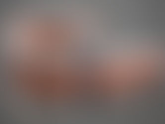 Carga inmediata en implantes dentales: qué es y en qué casos puede hacerse