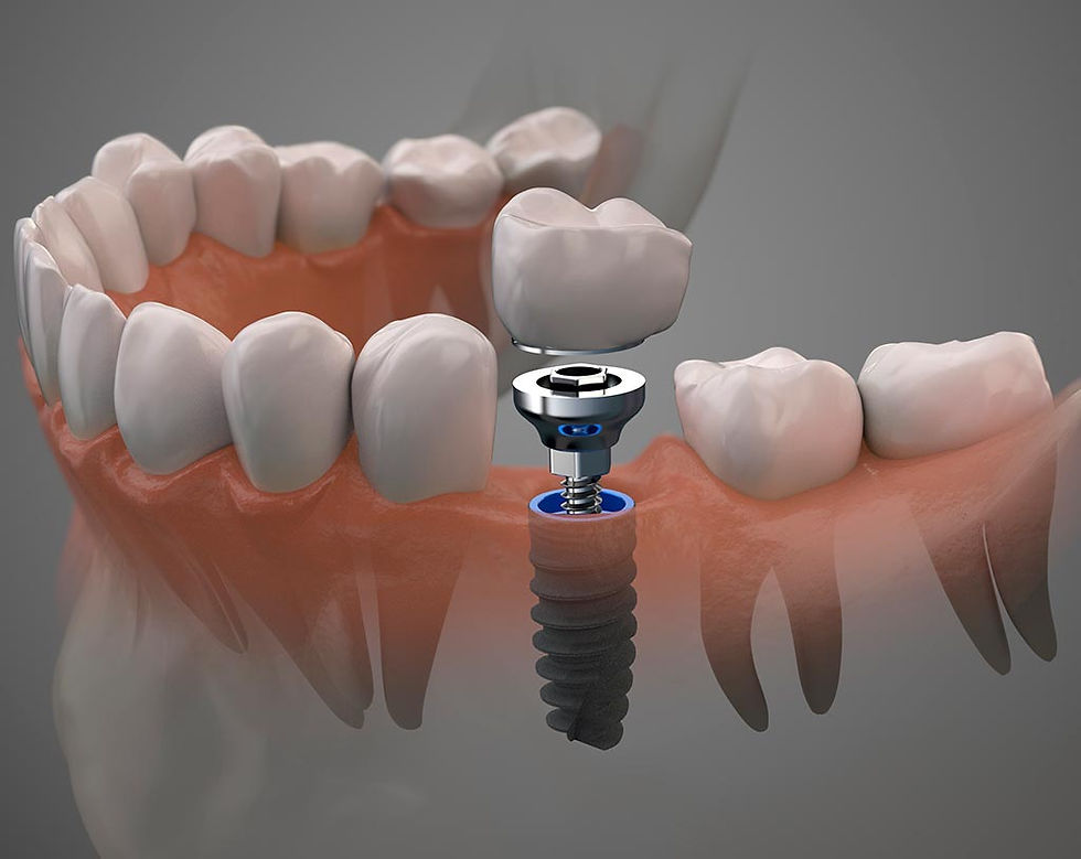 Carga inmediata en implantes dentales: qué es y en qué casos puede hacerse