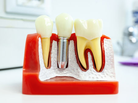 ¿Qué pasa si no hay hueso para un implante dental? Injerto óseo y otras soluciones