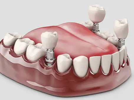 ¿Duele ponerse un implante dental? Lo que realmente nota el paciente