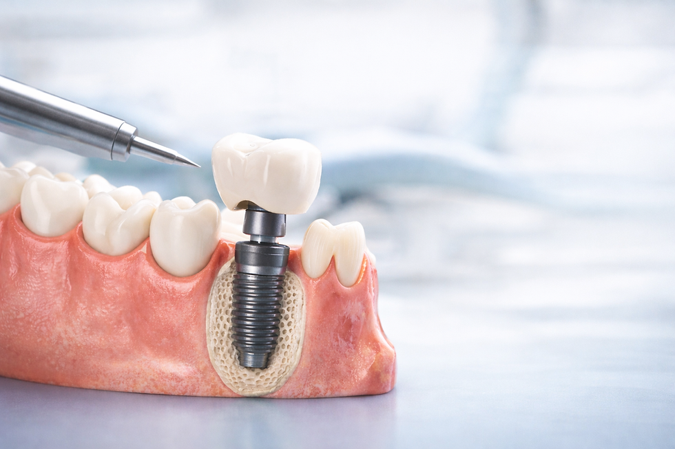 He perdido un diente: cuánto tiempo debería esperar para reponerlo con un implante