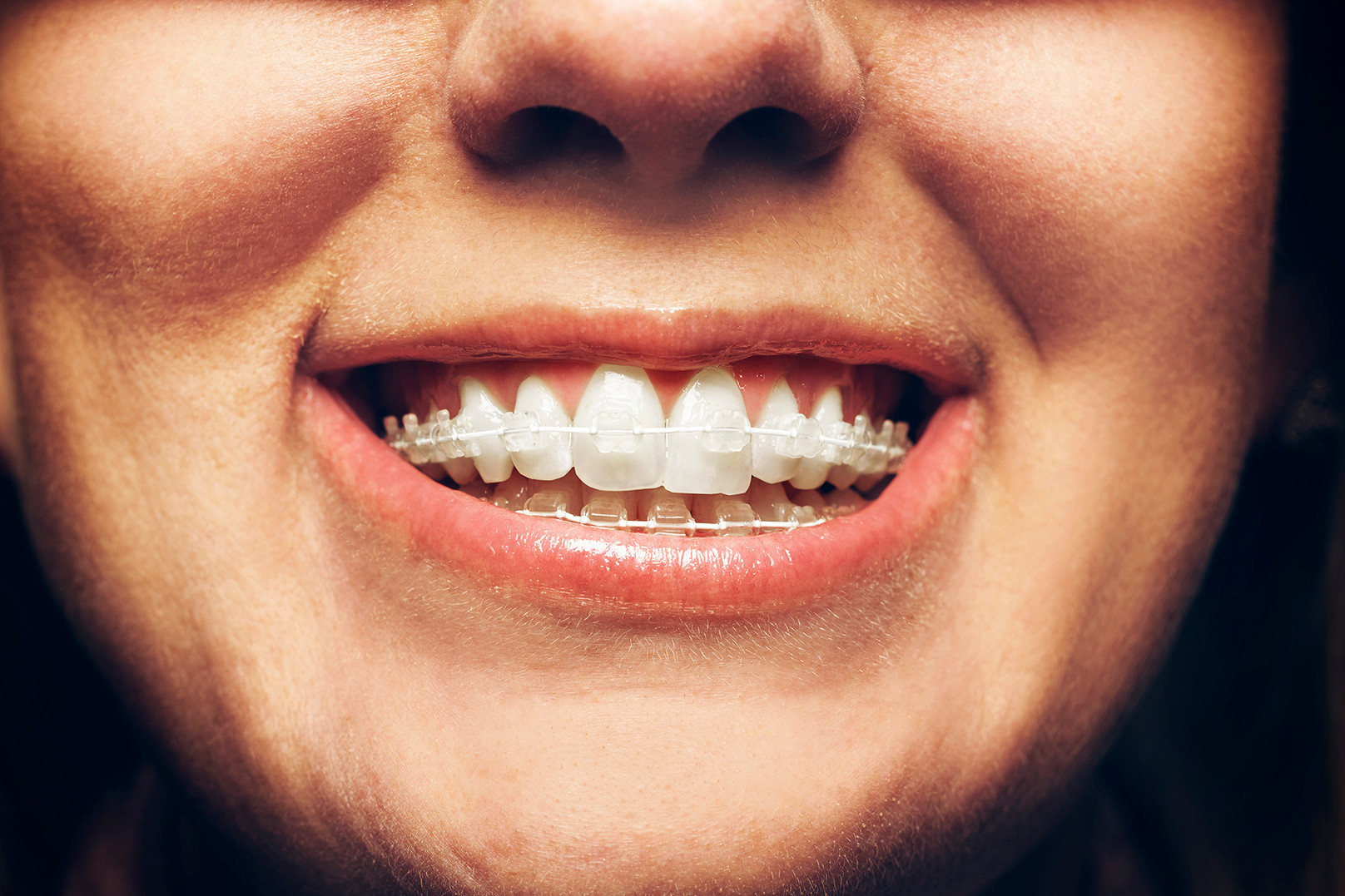 Six Month Smiles Braces Melton Mowbray The Melton Clinic