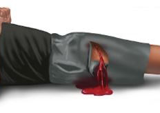 Illustration of a person lying down with a bleeding leg wound for first aid training.