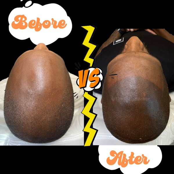 Scalp Micropigmentation Allure HOPE The Scalp Barber Sacramento SMP