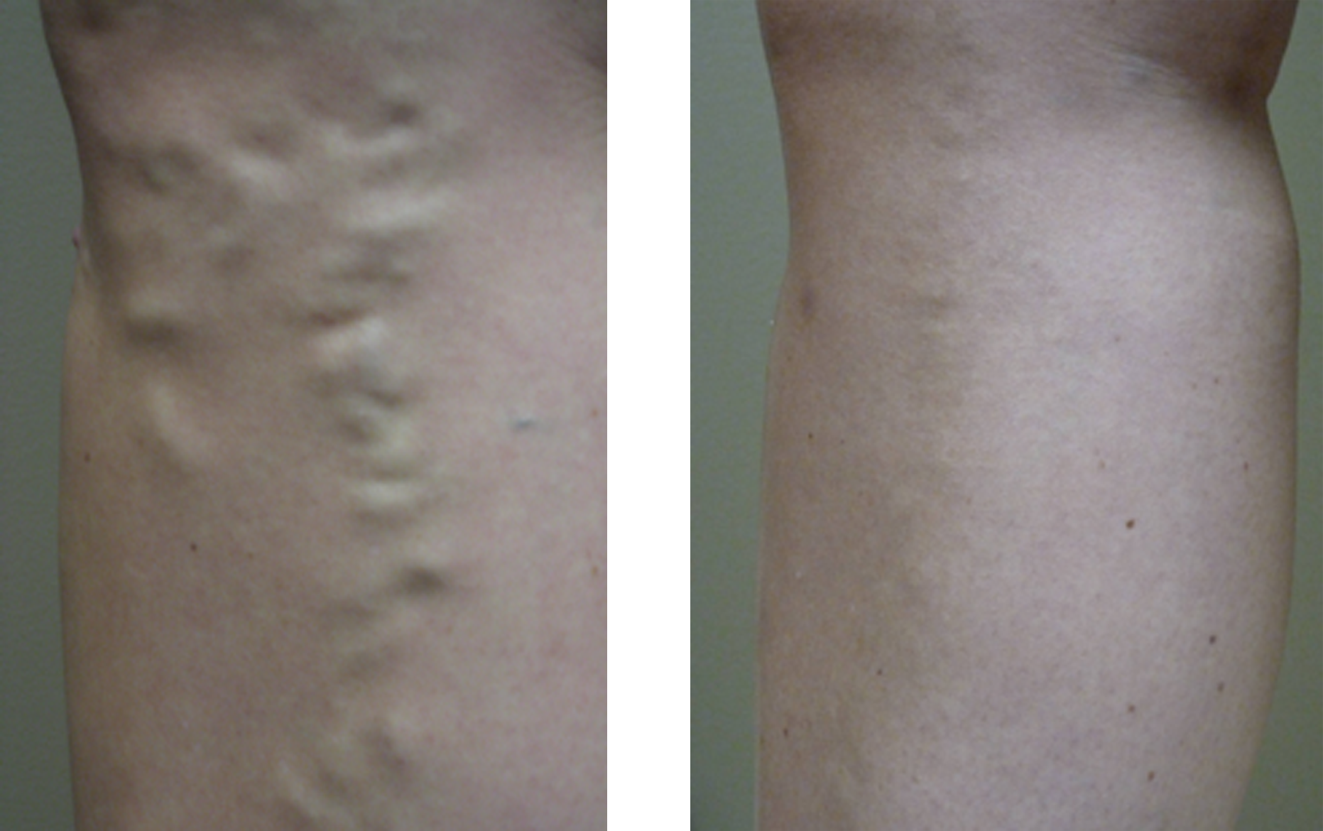 Vein Disease & Varicose Vein Treatment | Evansville, IN Owensboro, KY
