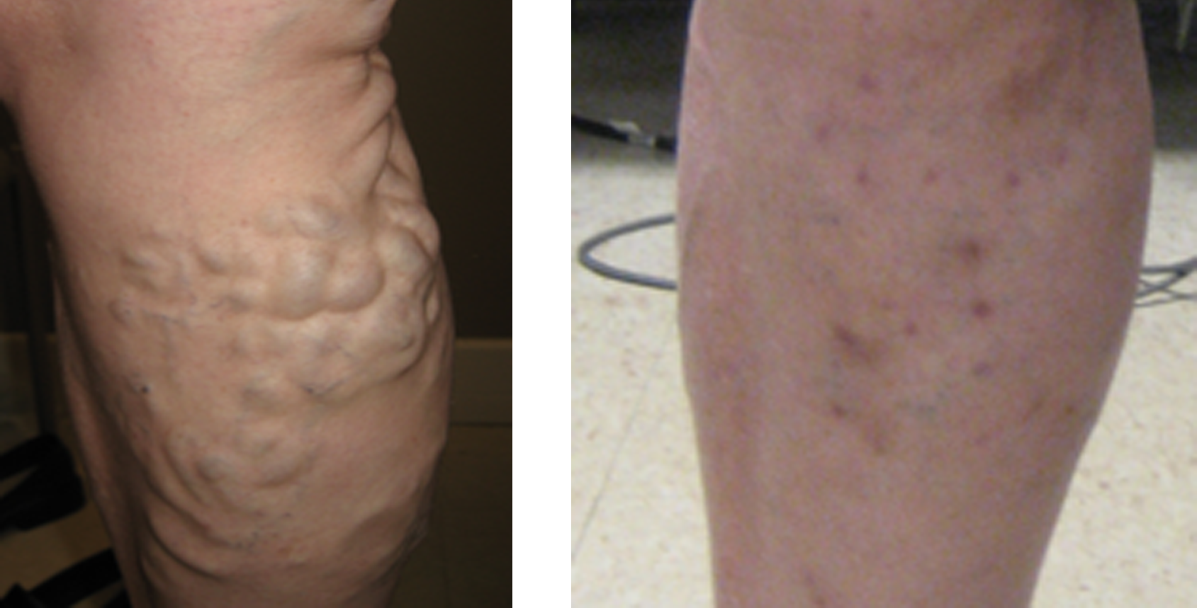 Vein Disease & Varicose Vein Treatment | Evansville, IN Owensboro, KY