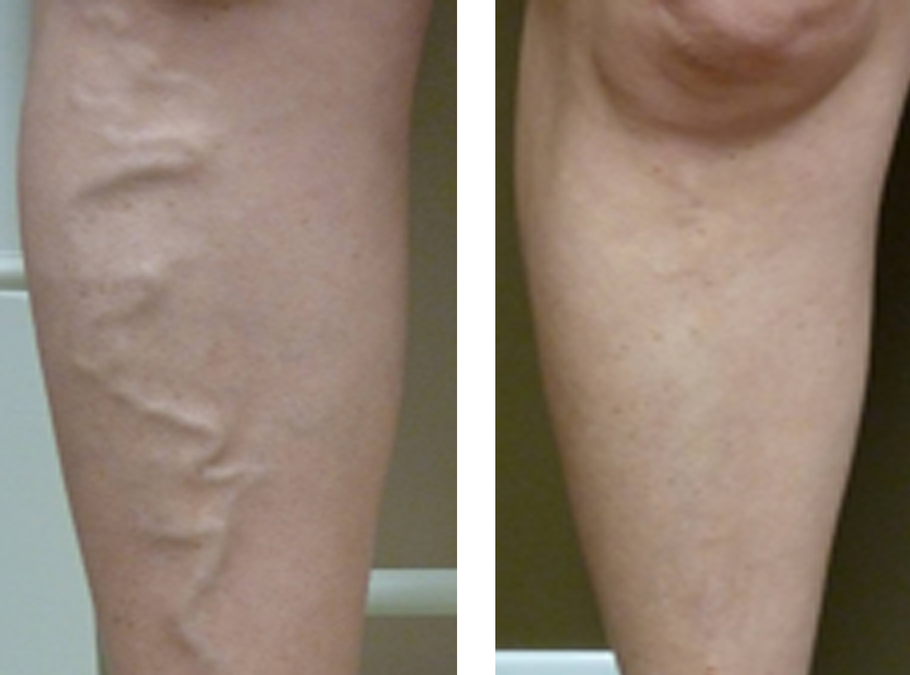 Vein Disease & Varicose Vein Treatment | Evansville, IN Owensboro, KY