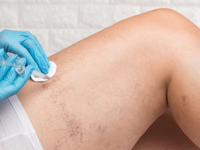 Cost of Spider Vein Treatments: What You Need to Know
