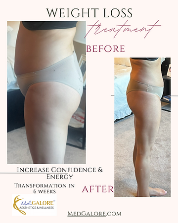 MedGalore weight loss before and after