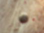 queratose 1
